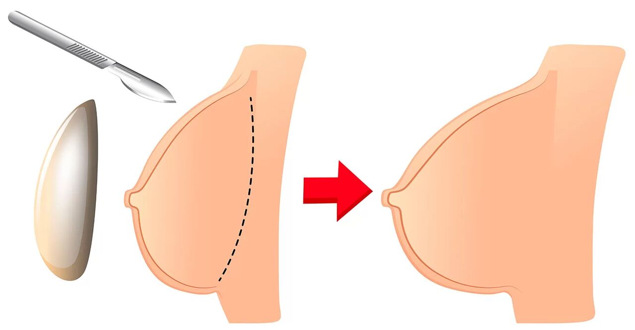 Brustvergréisserung mat engem Implantat