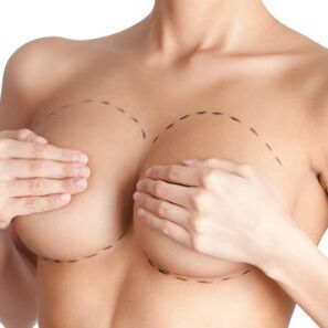 Aarte vun Implantater