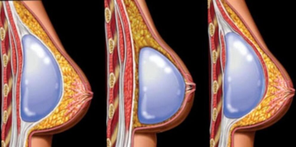 Installatioun vun Implantater